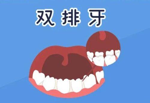 方丝弓矫正技术解析？一文揭秘方丝弓矫正牙的详细步骤及费用参考！ 