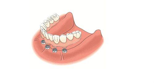 韩国美格真种植牙属于几线品牌？含此一线品牌种植牙齿寿命及收费价格一览