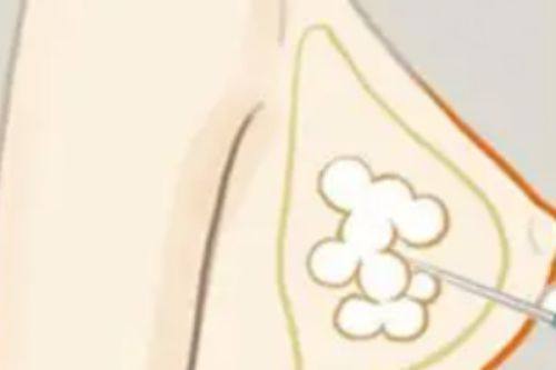 250和275假体之间差多少？解析两者手感区别及呈现的真实效果！ 