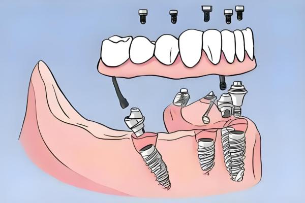 上海种植牙便宜又好的是哪家？美奥、摩尔、雅悦上榜可以用医保