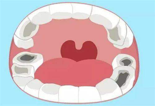 深圳一档社保补牙可以报销吗？详解深圳一档社保补牙报销比例及报销政策,看完秒懂！ 