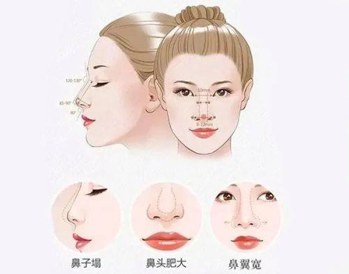液态骨雕多少钱一只？液态骨雕隆鼻3k~1.5w左右,长效维持可达5年多