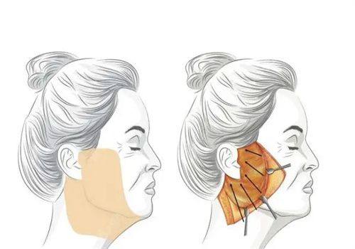 虞美人医院面部提升的价格：含埋线/拉皮/注射填充等多种提升价格公开