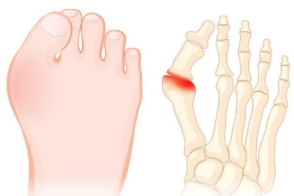北京马文足科做大脚骨手术怎么样？采用微孔技术创口小恢复快，手术性价比高值得选择