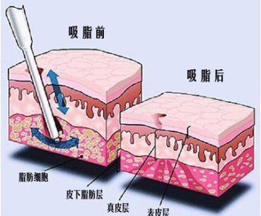 马桂娥吸脂好吗？专攻腹部/四肢等部位塑形,皮肤弹性与紧致度不减!附价格