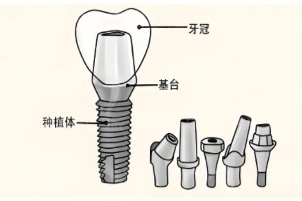 成都安玉口腔牙种植医院