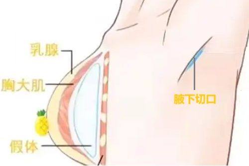 珠海韩妃那个医生做假体做好？周国伟医生技术好经验丰富，多术式打造自然美观效果！ 