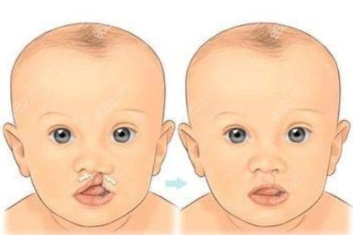 唇腭裂修复预约超全攻略：含挂号方式、唇腭裂修复医院排名及手术大概费用！ 