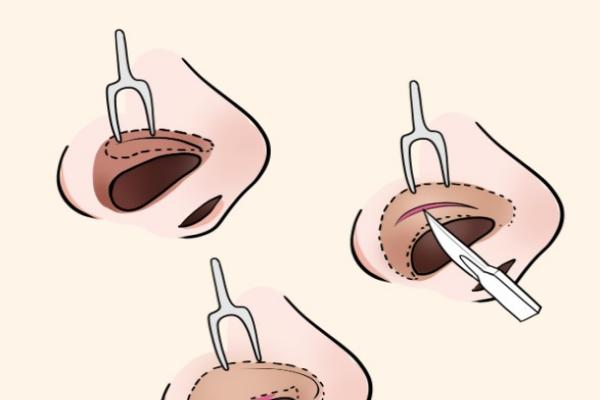 膨体隆鼻手术价格一般在8000元至50000元左右，受材料、医生等因素影响，膨体隆鼻效果如何？ 