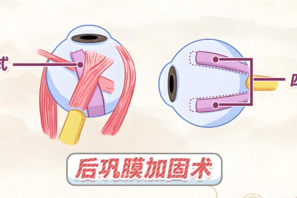 上海后巩膜加固术哪个医生好？褚仁远、翟爱琴、乔彤等排名榜靠前的医生值得推荐