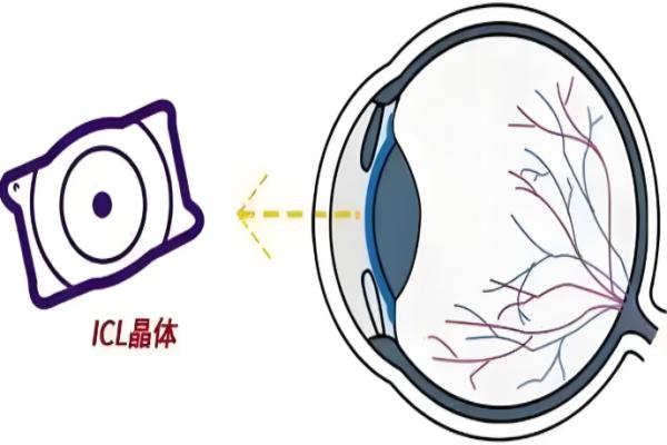 眼睛晶体植入是什么意思？是给眼睛装内置眼镜的视力矫正术，可逆安心价格3000起/眼 