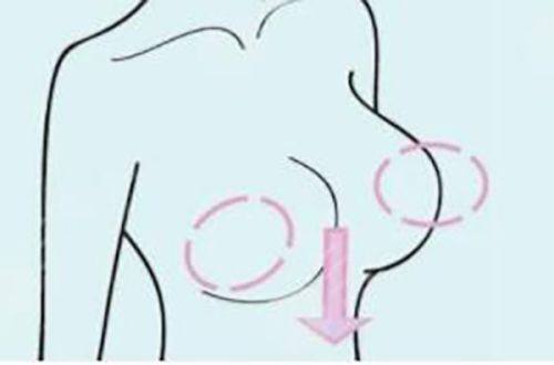 合肥维多利亚隆胸好吗?隆胸技术实力强/创伤小修复快/是靠谱的隆胸选择