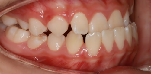 广州瑞泰口腔医院收费贵吗？不贵，种植牙2k+/颗+洗牙99起，性价比高靠谱机构