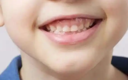 福州科尔口腔种植牙怎么样？院内微创种植技术靠谱，亲测好评多效果稳定舒适