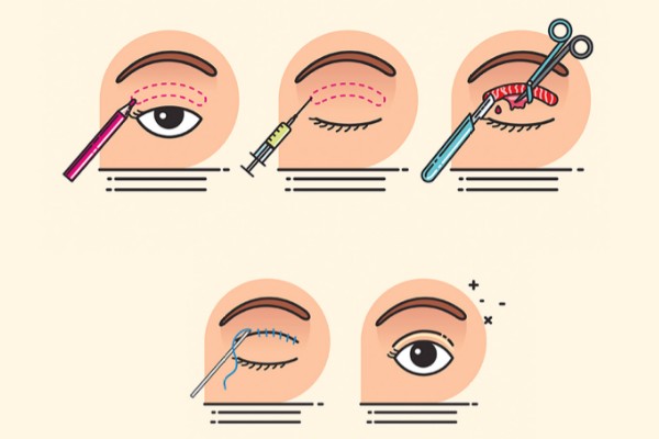 汉中名韩整形医院做双眼皮怎么样啊？名韩星星眼个性化设计，术前数字化模拟成效，价格2000元起