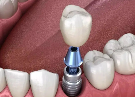 胶州益牙口腔镶牙怎么样？数字化修复技术精湛且收费亲民，亲测稳固美观超安心