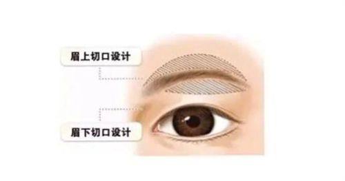 北京的张冰洁做双眼皮修复手术效果怎么样？高难度修复技术精湛收费透明自然灵动
