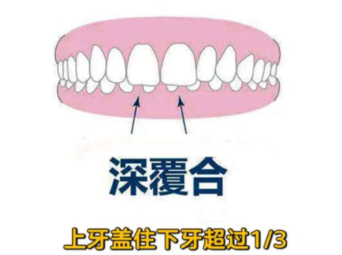 福州科尔口腔好贵？其实种植牙 2980+矫正 4800 元起性价比真的高