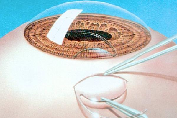 后巩膜加固术手术视频：能直观展示手术过程，价格适中技术成熟有保障 