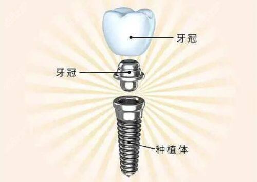 菏泽华忠口腔医院是什么医院？专注数字化种植技术，收费合理透明，亲测效果稳固可靠！