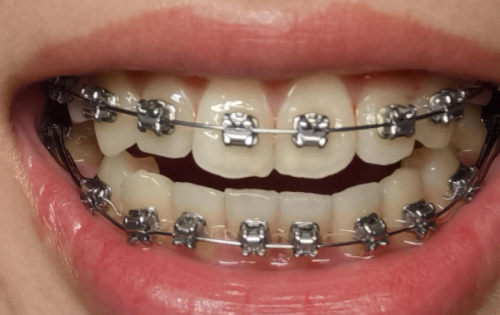 深圳友睦口腔李飒医生正畸技术好吗？擅长隐形矫正且收费合理，亲测效果稳定超赞！