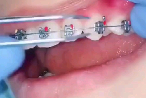 哈尔滨镶牙哪里好又便宜？选数字化精准修复技术靠谱且收费亲民，真实体验超赞