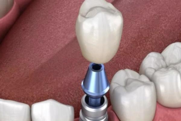 魏志香双眼皮价格因术式而异，埋线、全切、修复各有不同，20余年专注眼部整形效果超赞 