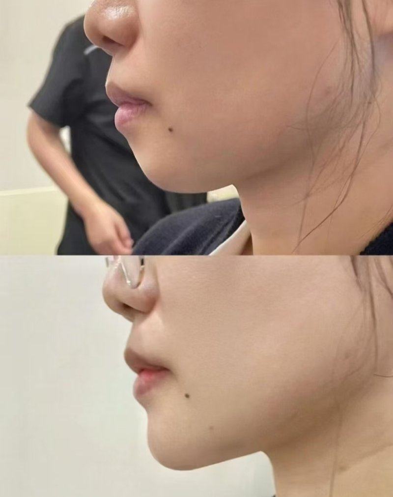 分享我在合肥找赵士俊做鼻翼缩小手术的经历效果如何？技术精细收费合理，鼻型自然灵动更自信。
