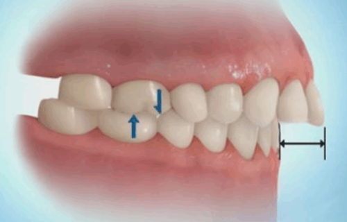 深圳格伦菲尔口腔评论可靠吗？种牙技术精湛收费亲民，亲测数字化种植效果超赞值得选