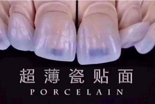 深圳格伦菲尔口腔收费多少？种牙矫正价格透明，结合口碑评价看真实花费更放心！