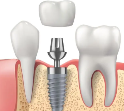 深圳格伦菲尔口腔靠谱吗？数字化种植技术精湛收费亲民，亲测修复效果自然稳固超安心