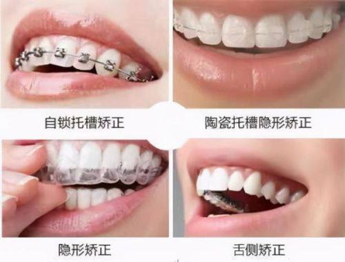 吸附性义齿和普通义齿有啥区别？稳固性更强吃饭更香技术先进舒适度高