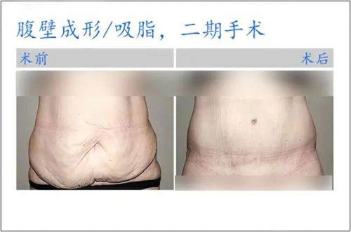 二、广州荔医异物取出真实实例分享:看她们如何摆脱噩梦重获新生www.360tulou.com/