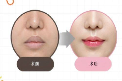 二、河南郑州整形美容医院吸脂价格贵吗？透明收费性价比极高值得冲www.360tulou.com/