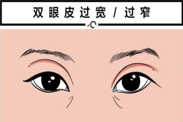 上海美莱杨光眼综合手术风格自然吗？甜伊严选可以预约了解医师审美特点